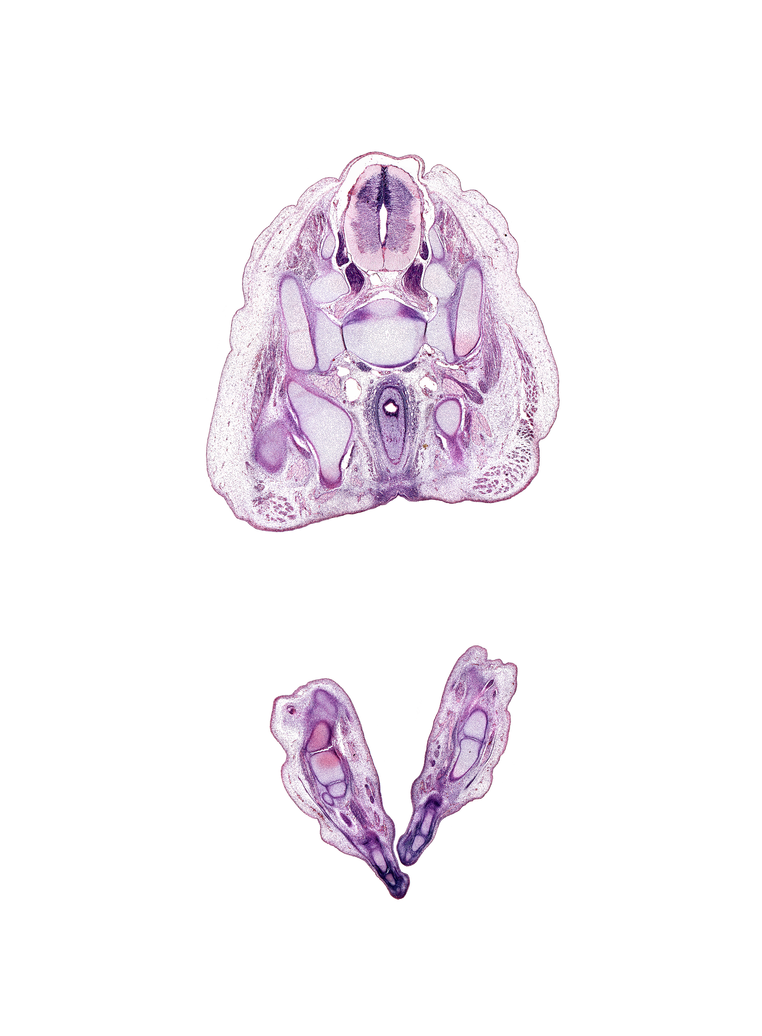 L-5 spinal ganglion, S-1 / S-2 intervertebral region, S-1 spinal ganglion, S-1 ventral primary ramus, anal pit, anal sphincter, calcaneum, cuboid, dorsal interosseus muscle, dorsum of foot, dura mater, extensor digitorum brevis muscle, extensor digitorum longus tendon, gluteus maximus muscle, ilium, ischial tuberosity, lateral plantar nerve, left common iliac vein, metatarsal 4, metatarsal 4 base, pelvic ganglia, plantar side of foot, rectum, sacral plexus, sacro-iliac joint, subarachnoid space