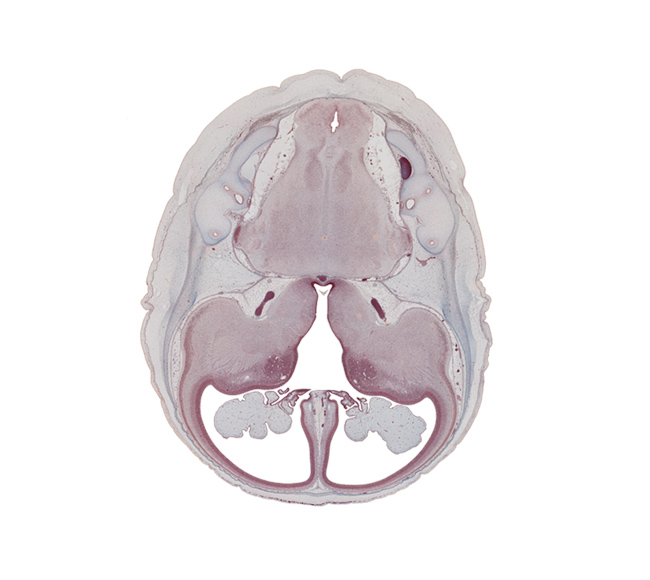 anterior semicircular duct, caudate nucleus, central canal, choroid plexus, common limb of semicircular duct, falx cerebri region, hippocampus, insula of cerebral hemisphere, internal carotid artery, interventricular foramen, lateral ventricle, medial accessory olivary nucleus, middle cerebral artery, posterior semicircular duct, pyramidal tract region, root of cranial accessory nerve (CN XI), root of glossopharyngeal nerve (CN IX), root of trigeminal nerve (CN V), root of vagus nerve (CN X), roots of vagus and cranial accessory nerves (CN X and CN XI), semispinalis capitis muscle, spinal tract of trigeminal nerve (CN V), third ventricle