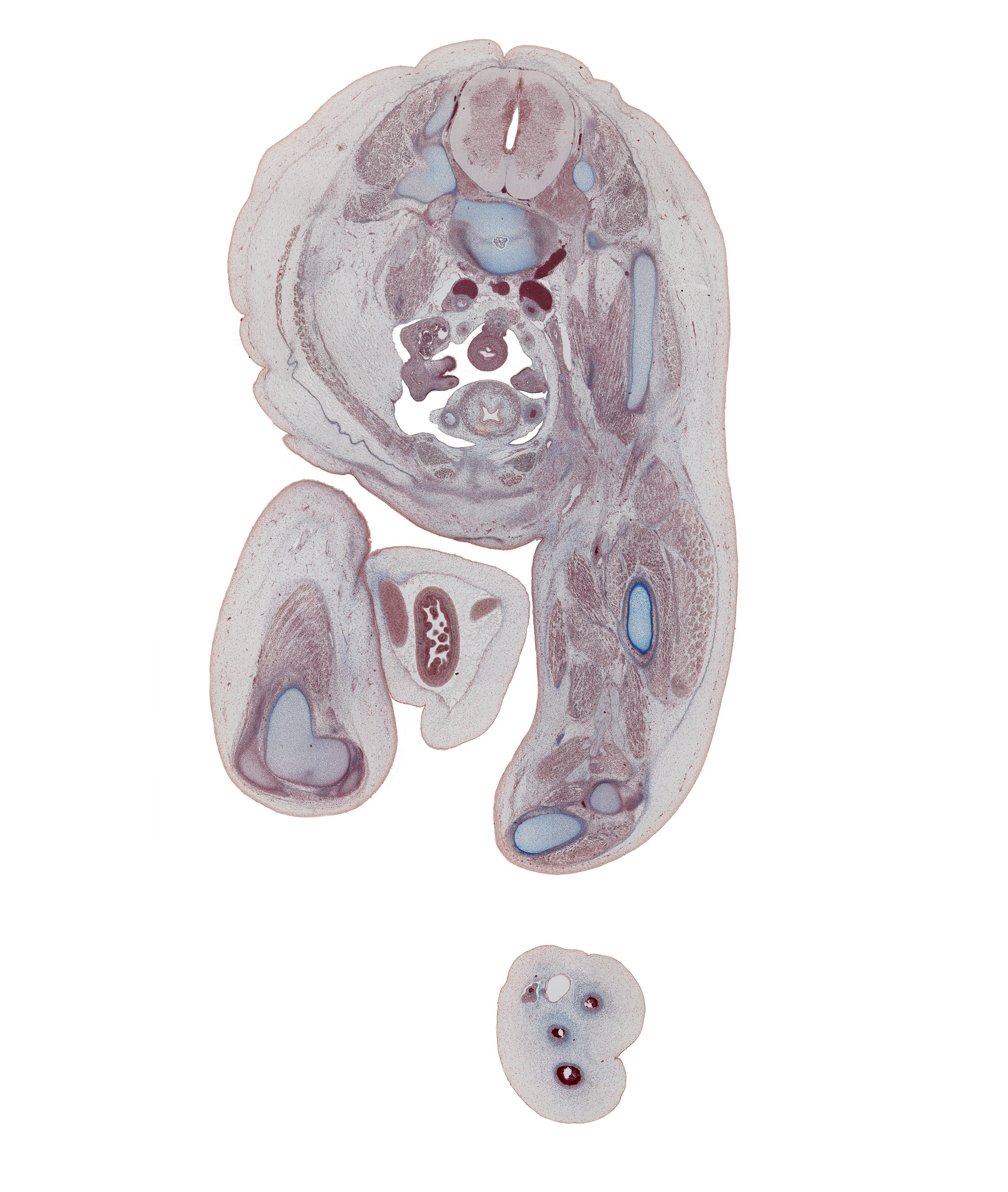 L-4 spinal ganglion, L-4 spinal nerve, adductor longus muscle, adductor magnus muscle, biceps femoris muscle, common fibular nerve, external abdominal oblique muscle, external iliac artery, femoral artery, femoral nerve, femur, gracilis muscle, gubernaculum of testis, head of fibula, herniated intestines, iliacus muscle, inferior epigastric artery, internal abdominal oblique muscle, lateral head of gastrocnemius muscle, left common iliac artery, left common iliac vein, medial head of gastrocnemius muscle, mesosigmoid, opening of paramesonephric duct, popliteus muscle, psoas major muscle, pyramidalis muscle, rectus abdominis muscle, right common iliac artery, sciatic nerve, semimembranosus muscle, semitendinosus tendon, sigmoid colon, tibia, tibial nerve, transversus abdominis muscle, umbilical coelom, umbilical cord, ureter, vas deferens