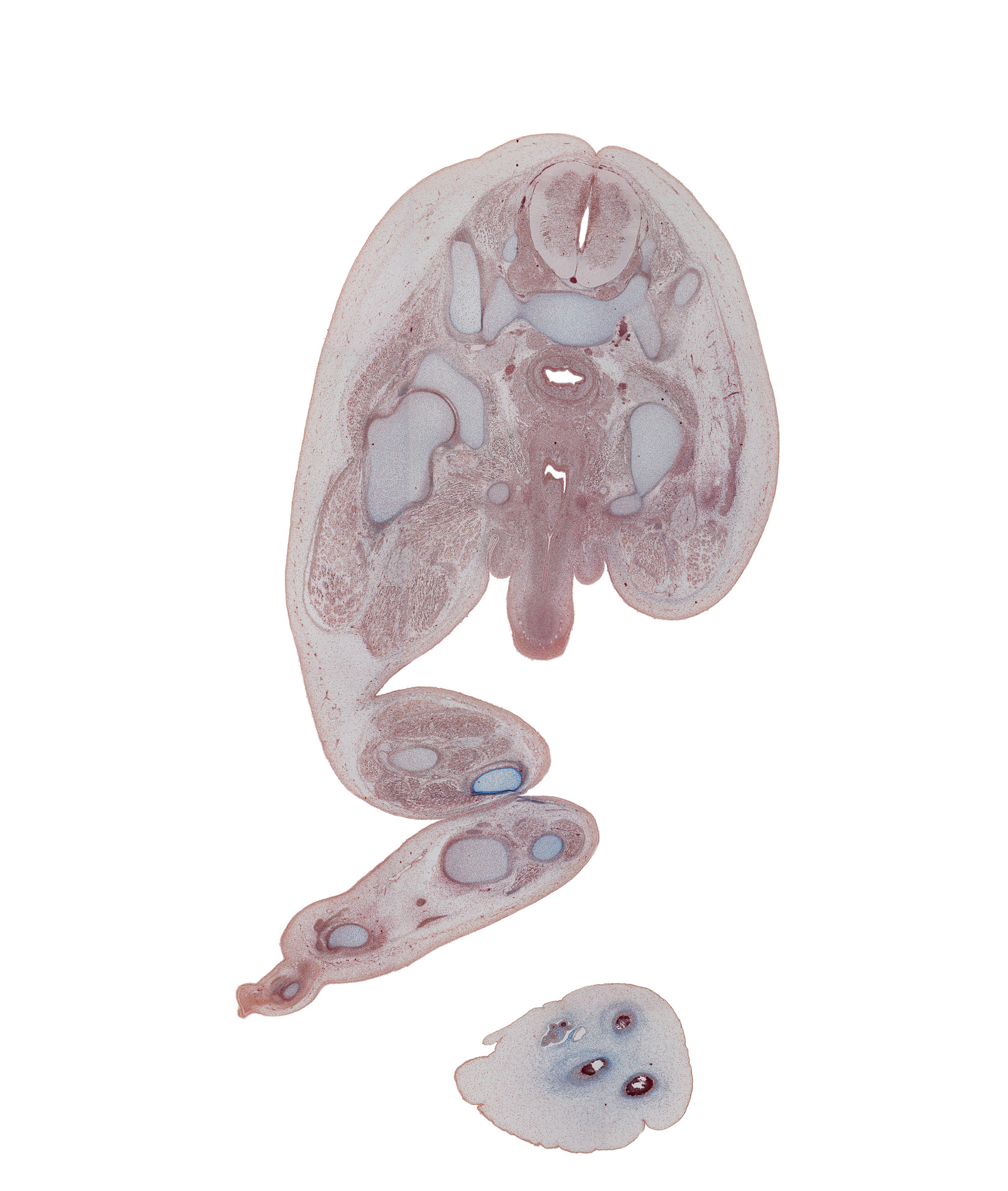 S-1 / S-2 interganglion region, ala of sacrum, anterior spinal artery, calcaneal tendon, corpus spongiosum, dorsal horn of grey matter, extensor digitorum longus tendon, extensor hallucis longus tendon, fibula, fibularis longus and fibularis brevis muscles, flexor digitorum longus tendon, flexor hallucis longus muscle, fused paramesonephric ducts, gluteus medius muscle, greater trochanter of femur, hip joint, ischial tuberosity, ischiopubic ramus, metatarsal 1, penile urethra, penis, phalynx of digit 2 (foot), piriformis muscle, rectum, sacro-iliac joint, sciatic nerve, scrotal swelling, sympathetic trunk, tibia, tibialis anterior tendon, tibialis posterior tendon, vas deferens, ventral horn of grey matter