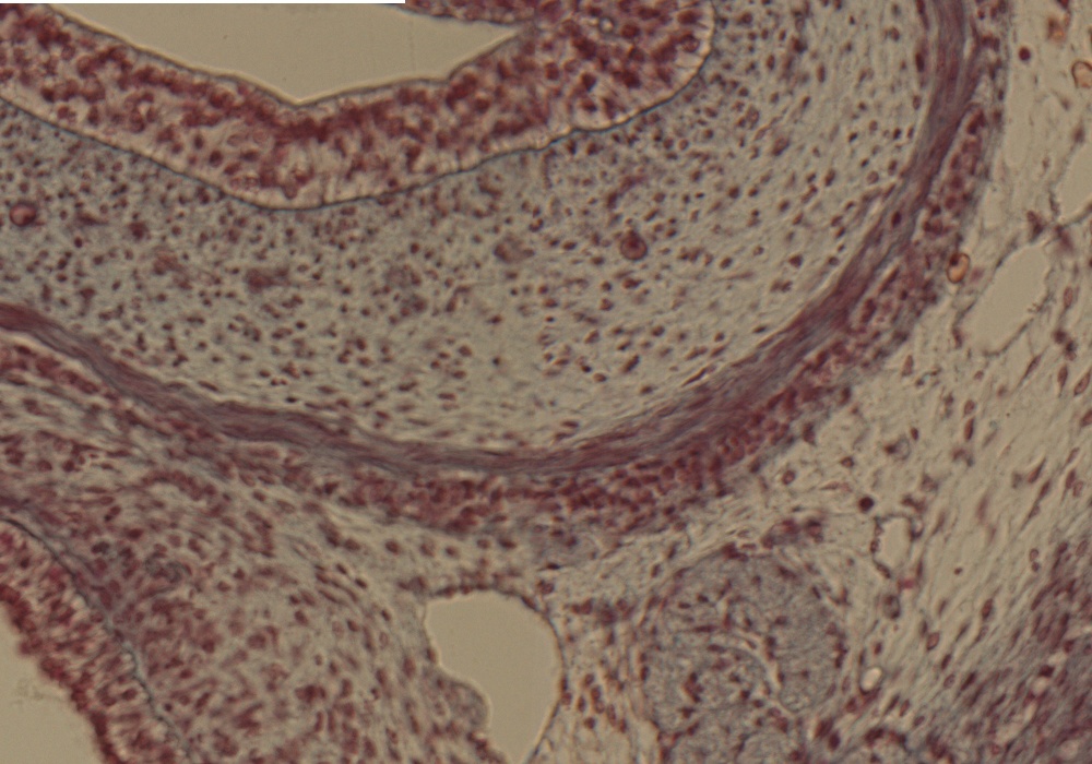 Esophagus Wall in Sup. Mediastinum