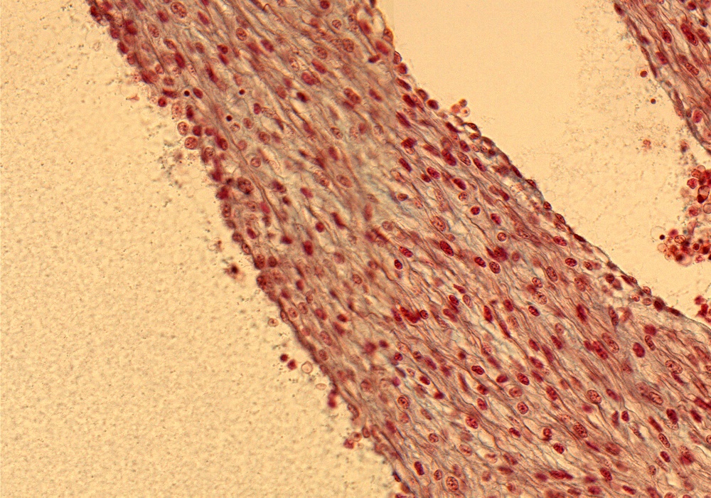 Rt. Ventricle Papillary M.