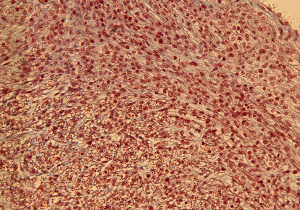 Interventricular Septum