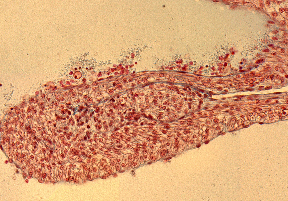 Lt. Pulmonary V.