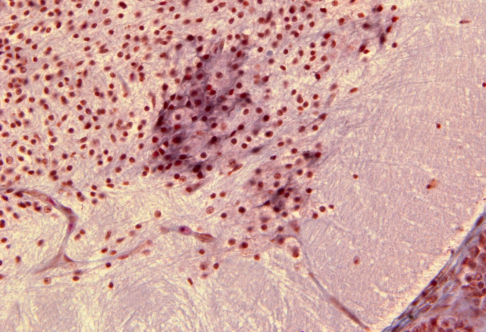 Ventricular Horn in Lumbar Region