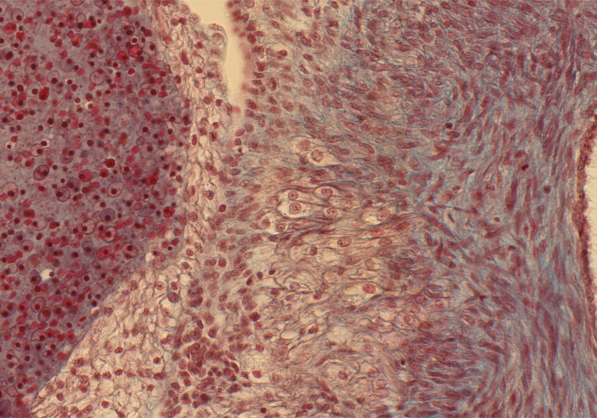 Pulmonary A. Wall and Rt. Ventricle Wall