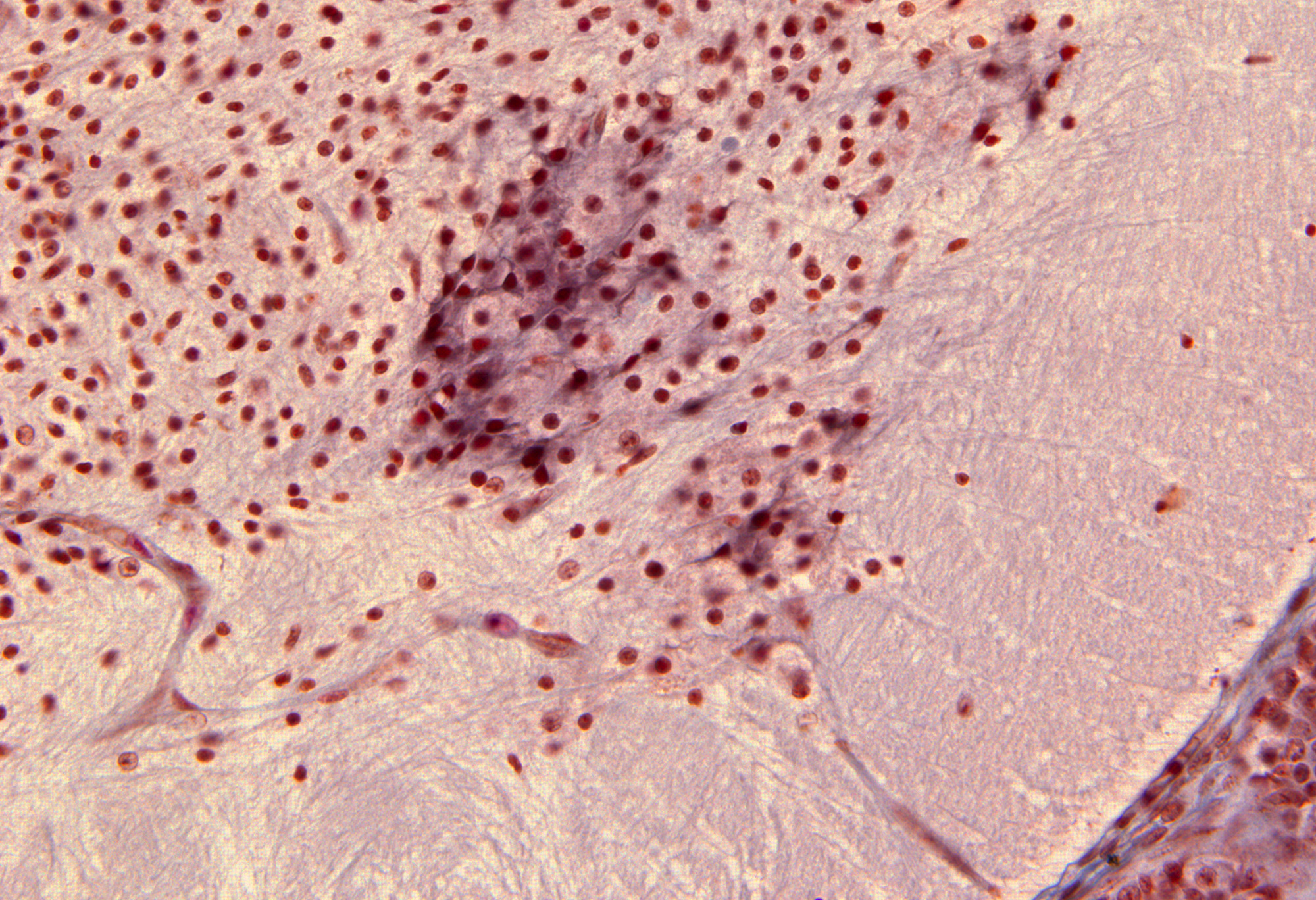 Ventricular Horn in Lumbar Region