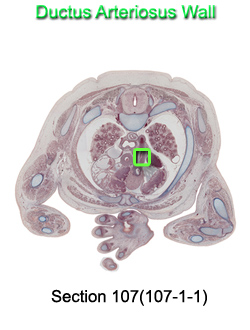 Ductus Arteriosus Wall