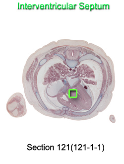 Interventricular Septum