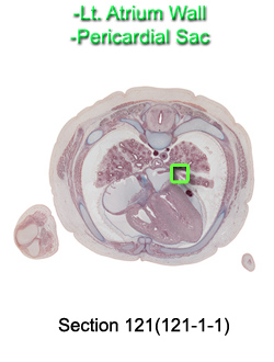 Lt. Atrium Wall and Pericardial Sac