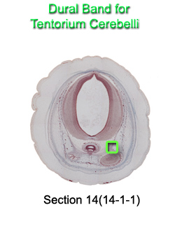 Dural Band for Tentorium Cerebelli