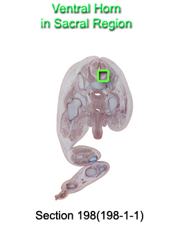 Ventricular Horn in Sacral Region