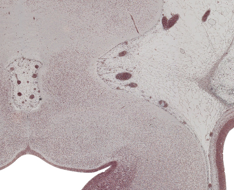 Basis Pedunculi Region and Edge of Interpeduncular Fossa