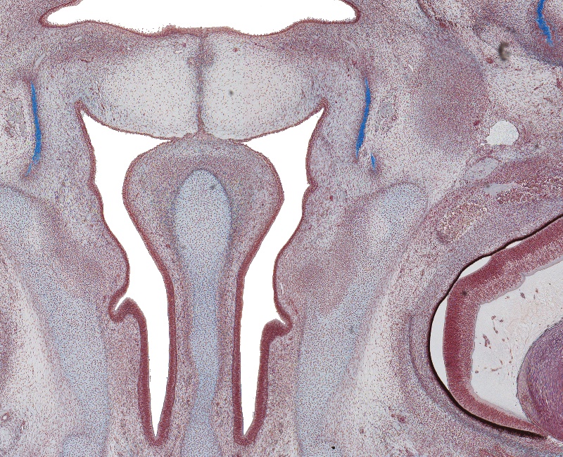 Fusing Palantine Shelves and Nasal Cavity