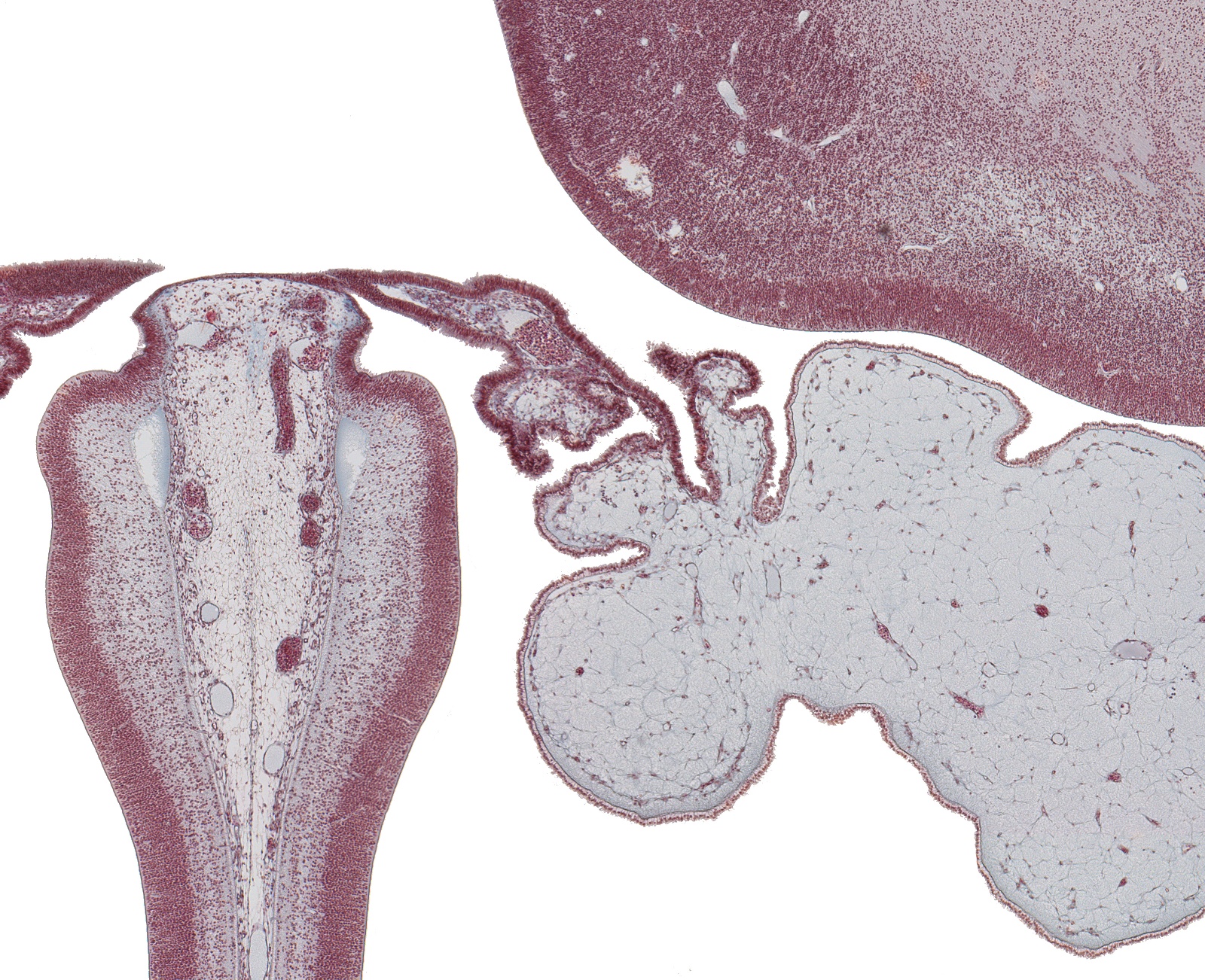 Cerebral Hemisphere at Interventricular Foramen