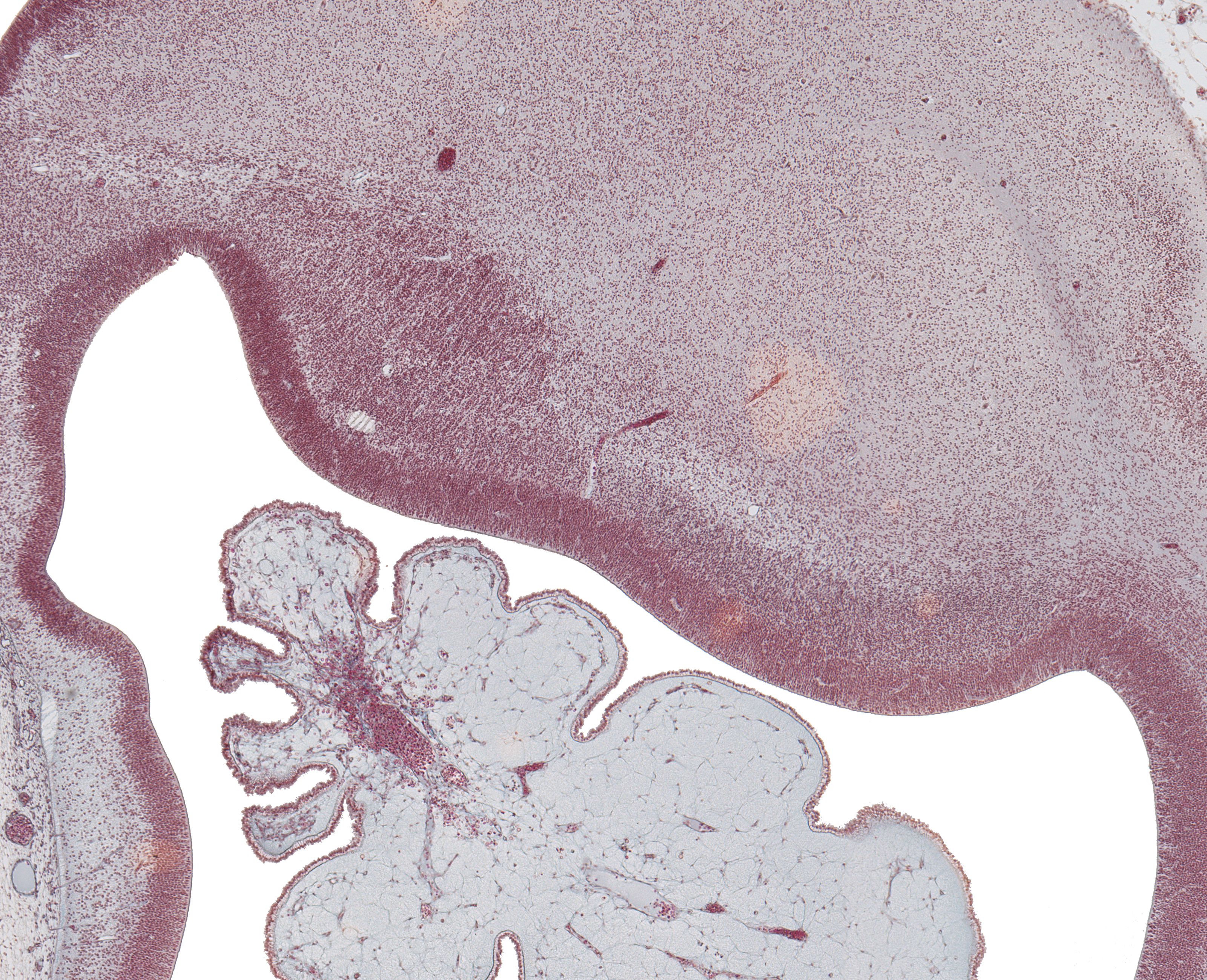 Med. and Lat. Eminence in Lateral Ventricle