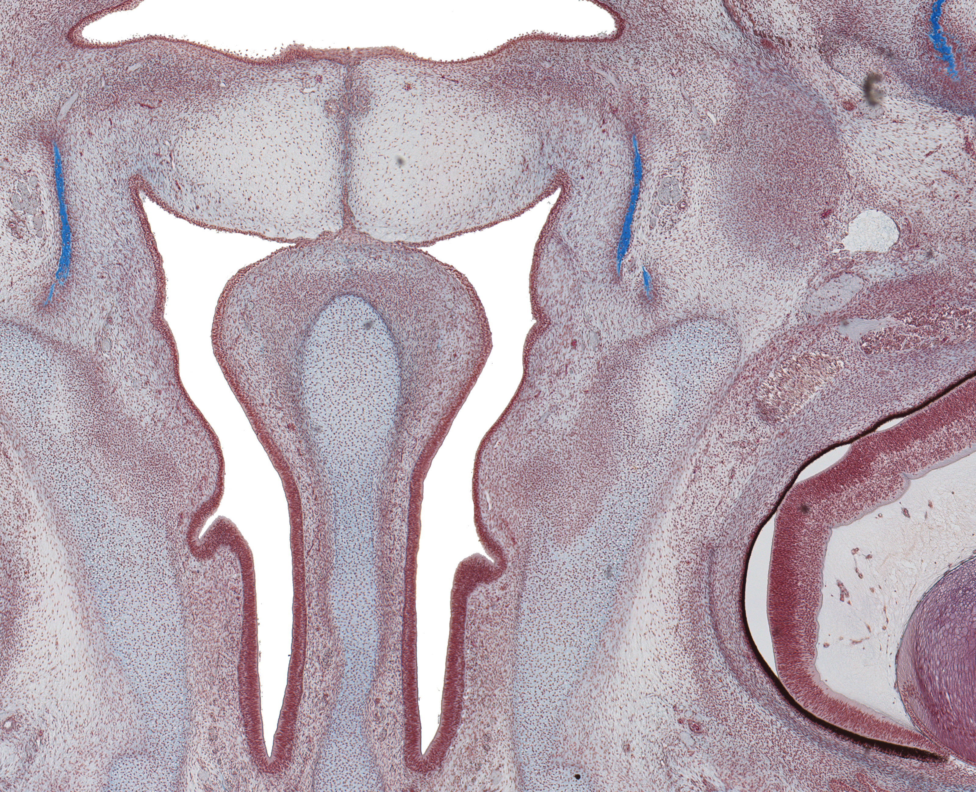 Fusing Palantine Shelves and Nasal Cavity