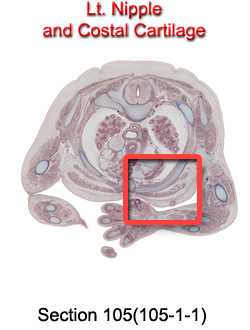 Lt. Nipple and Costal Cartilage