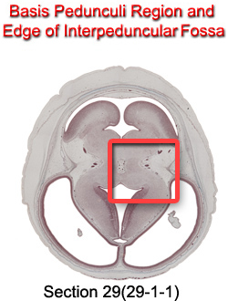 Basis Pedunculi Region and Edge of Interpeduncular Fossa