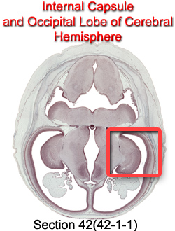 Internal Capsule and Occipital Lobe of Cerebral Hemisphere