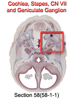 Cochlea, Stapes, CN VII, and Geniculate Ganglion