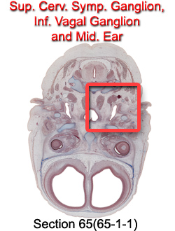 Sup. Cerv. Symp. Ganglion, Inf. Vagal Ganglion, and Mid. Ear