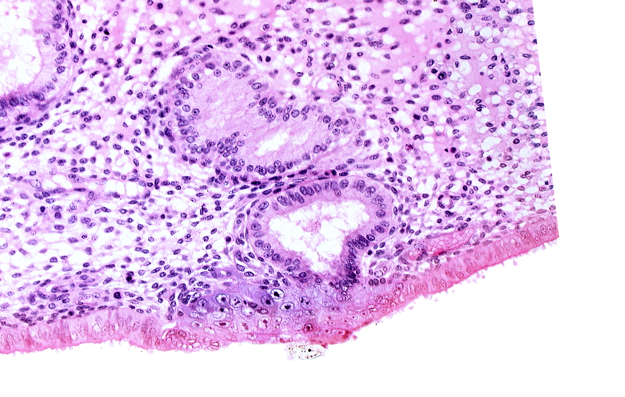 disrupted endometrial epithelium, edematous endometrial stroma (decidua), endometrial gland, solid syncytiotrophoblast, syncytiotrophoblast / decidua interface