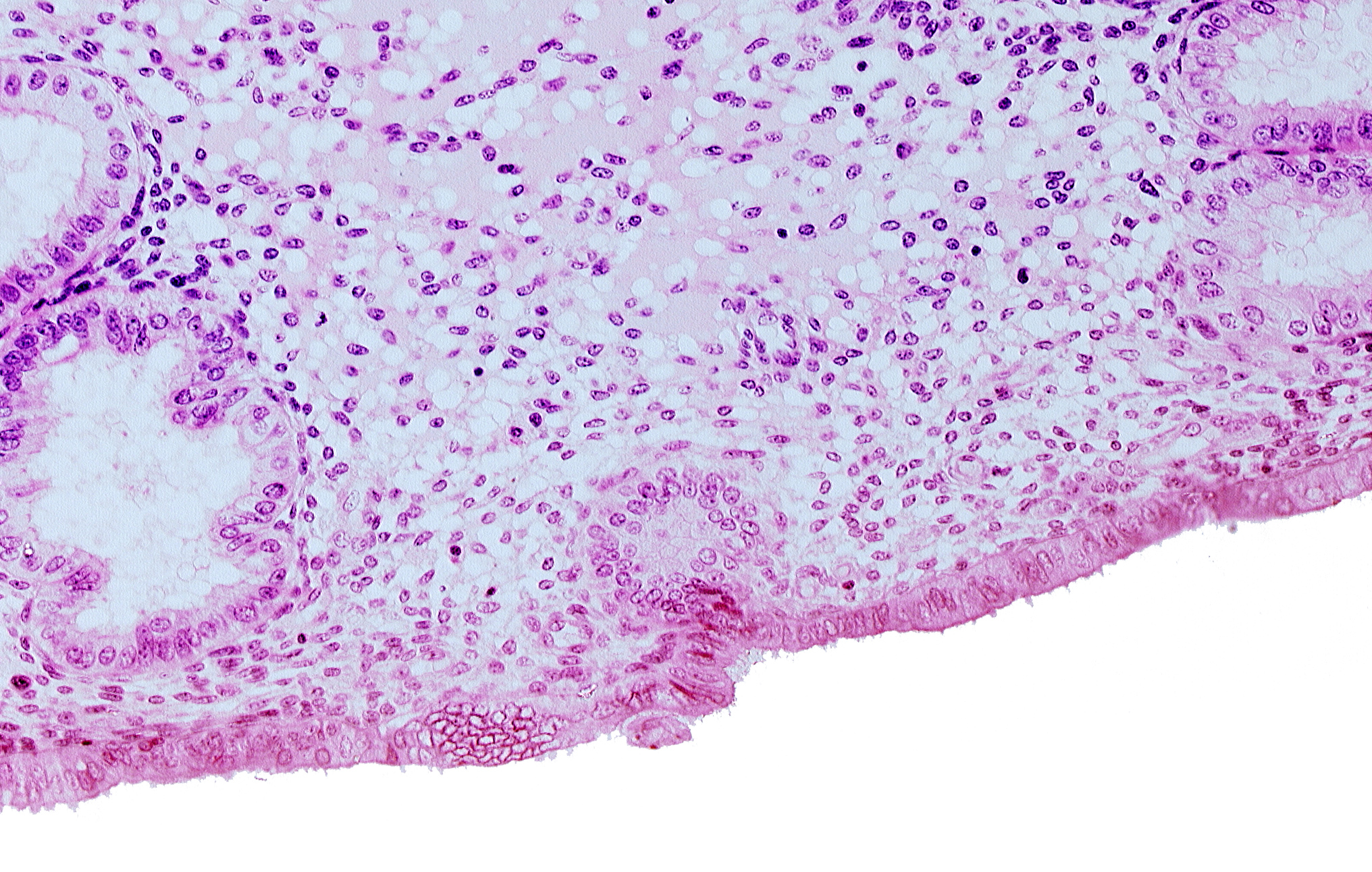 disrupted endometrial epithelium, edematous endometrial stroma (decidua), endometrial epithelium, endometrial gland