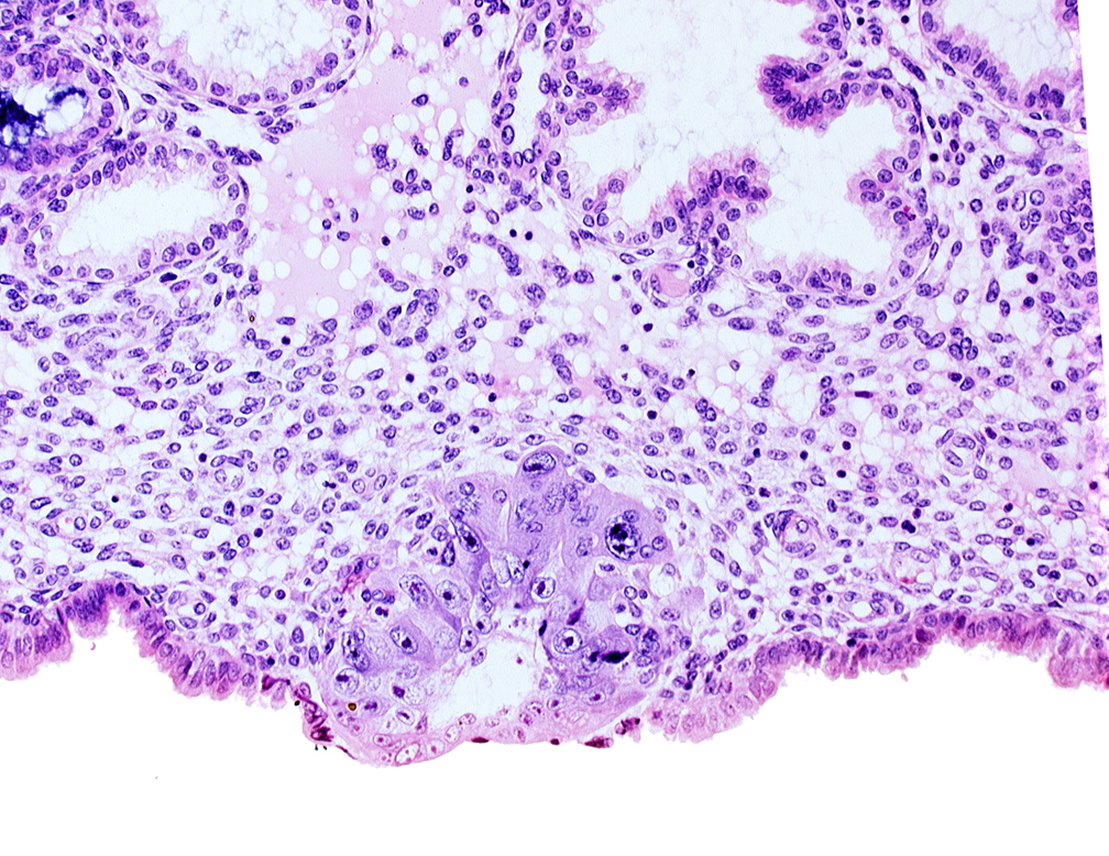 blastocystic cavity (blastocoele), cytotrophoblast, edematous endometrial stroma (decidua), endometrial epithelium, solid syncytiotrophoblast, syncytiotrophoblast / decidua interface