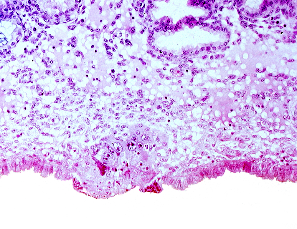 cytotrophoblast, edematous endometrial stroma (decidua), endometrial epithelium, solid syncytiotrophoblast, uterine cavity