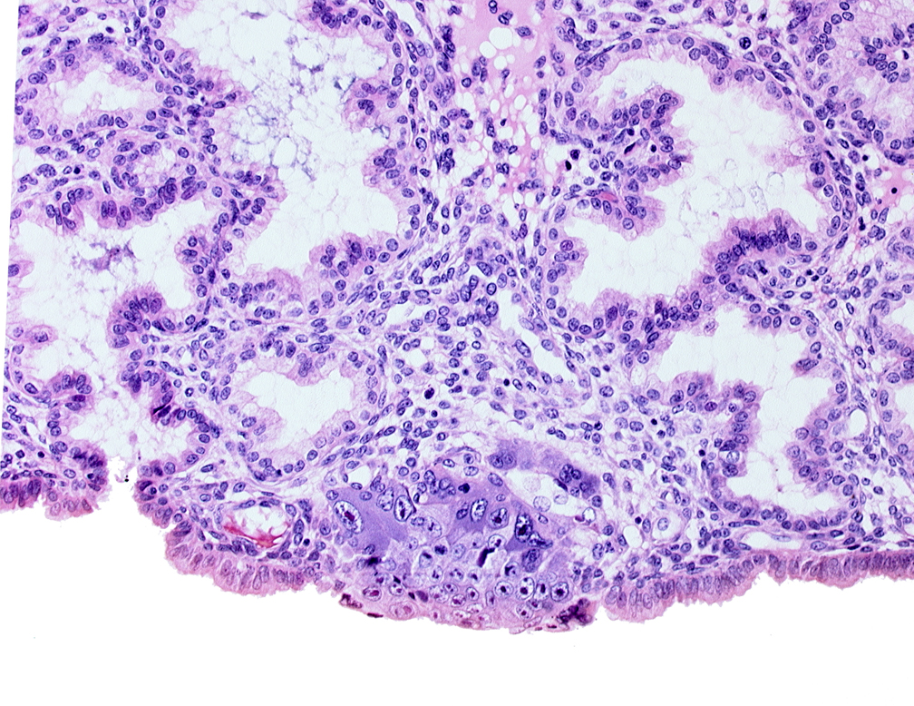 cytotrophoblast, endometrial epithelium, endometrial sinusoid, endometrial stroma (decidua), mouth of adjacent endometrial gland, solid syncytiotrophoblast