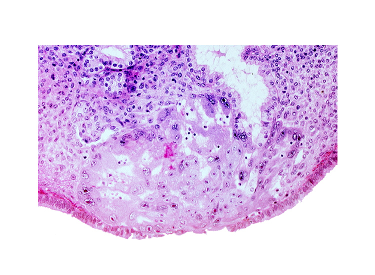 disrupted endometrial epithelium, lumen of endometrial gland, maternal blood cells in lacunae