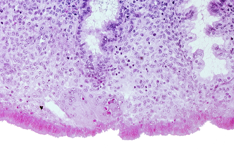 edematous endometrial stroma (decidua), endometrial sinusoid, intact endometrial epithelium, lumen of endometrial gland, uterine cavity