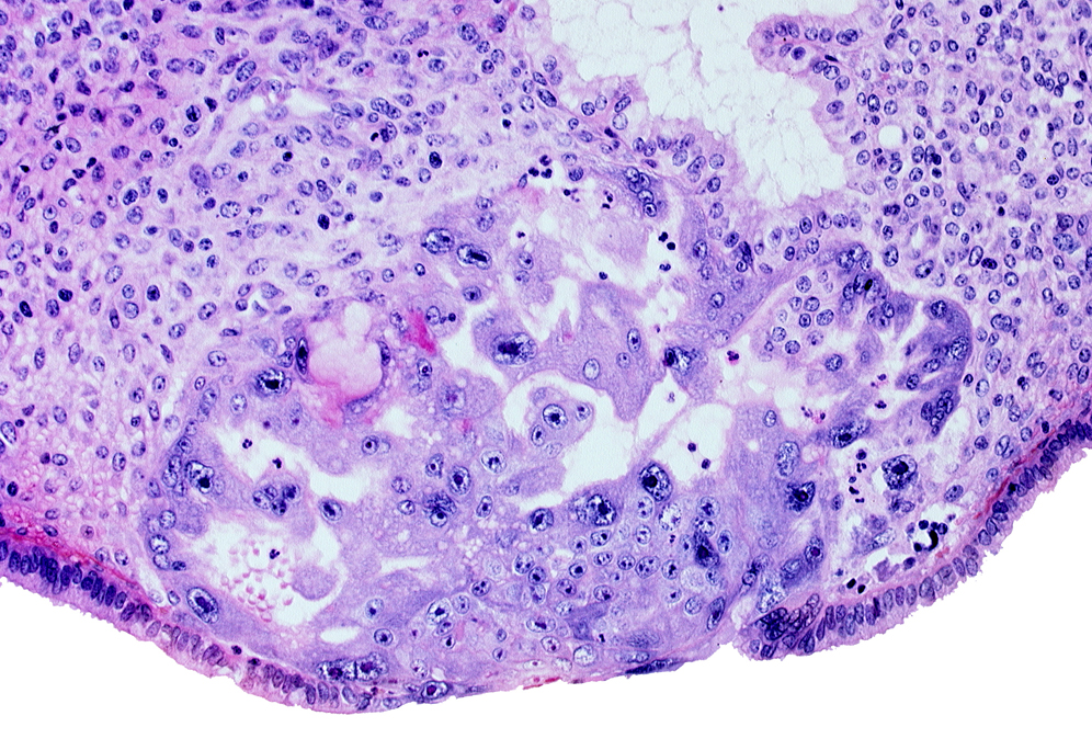 disrupted endometrial epithelium, endometrial gland, intact endometrial epithelium, uterine cavity