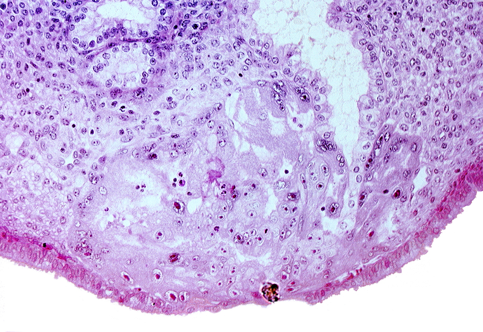 disrupted endometrial epithelium, lumen of endometrial gland, maternal blood cells in lacunae, syncytiotrophoblast, syncytiotrophoblast engulfing endometrial gland cells