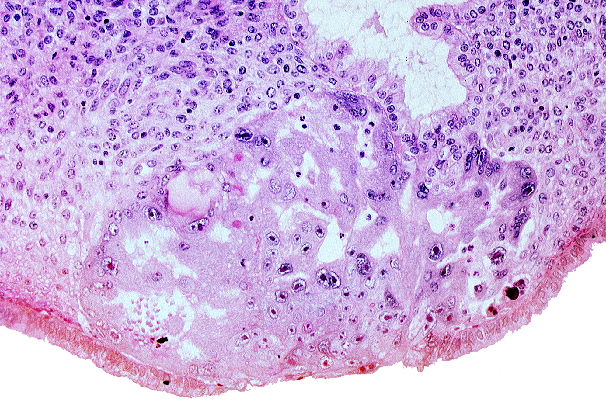 disrupted endometrial epithelium, edematous endometrial stroma (decidua), endometrial gland, intact endometrial epithelium, syncytiotrophoblast, uterine cavity