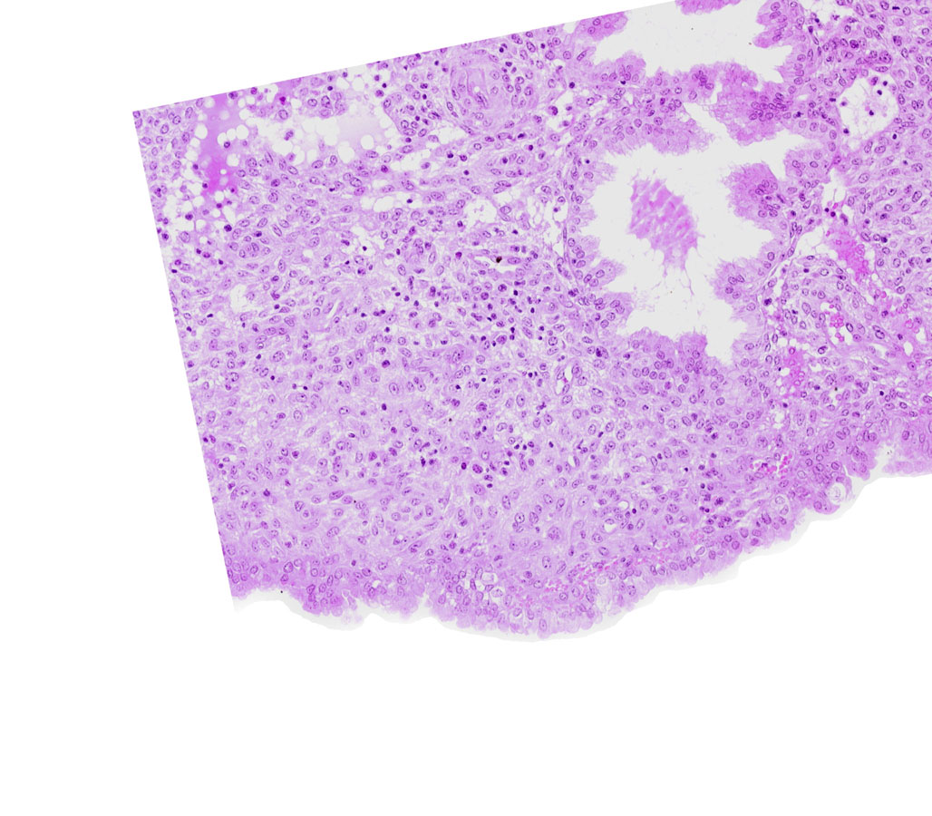 endometrial stroma (decidua), intact endometrial epithelium, uterine cavity