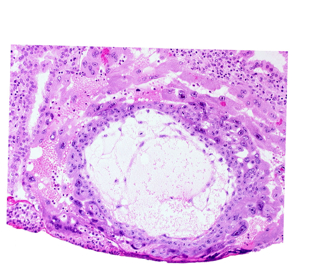 chorionic cavity, disrupted endometrial epithelium, uterine cavity