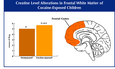 Graph of Creatine level alterations in frontal white matter of cocaine-exposed children