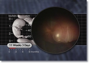 11 weeks 3 days fetus, Fetal Facial Expressions, Lips and Nose Complete, Fetus