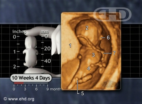 Bowel Herniation Resolved