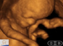 4D Ultrasound