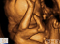 4D Ultrasound