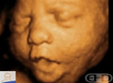 4D Ultrasound