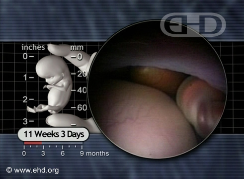 Amnion and Umbilical Cord