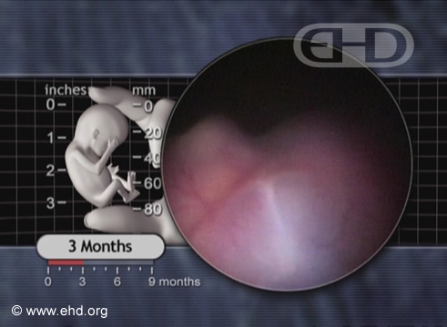 Left Eye With Fused Eyelids