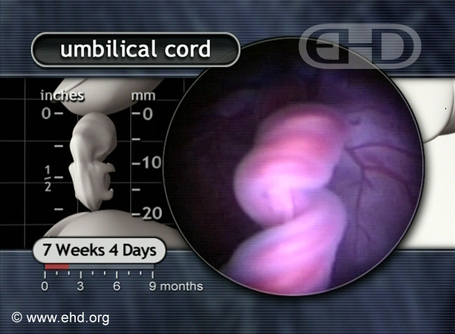 Close-up, Umbilical Cord at 7½ Weeks [Click for next image]